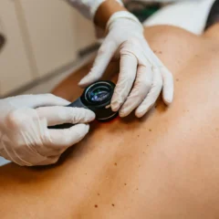 Skin Cancer Screening: Why Regular Checks Can Save Your Life